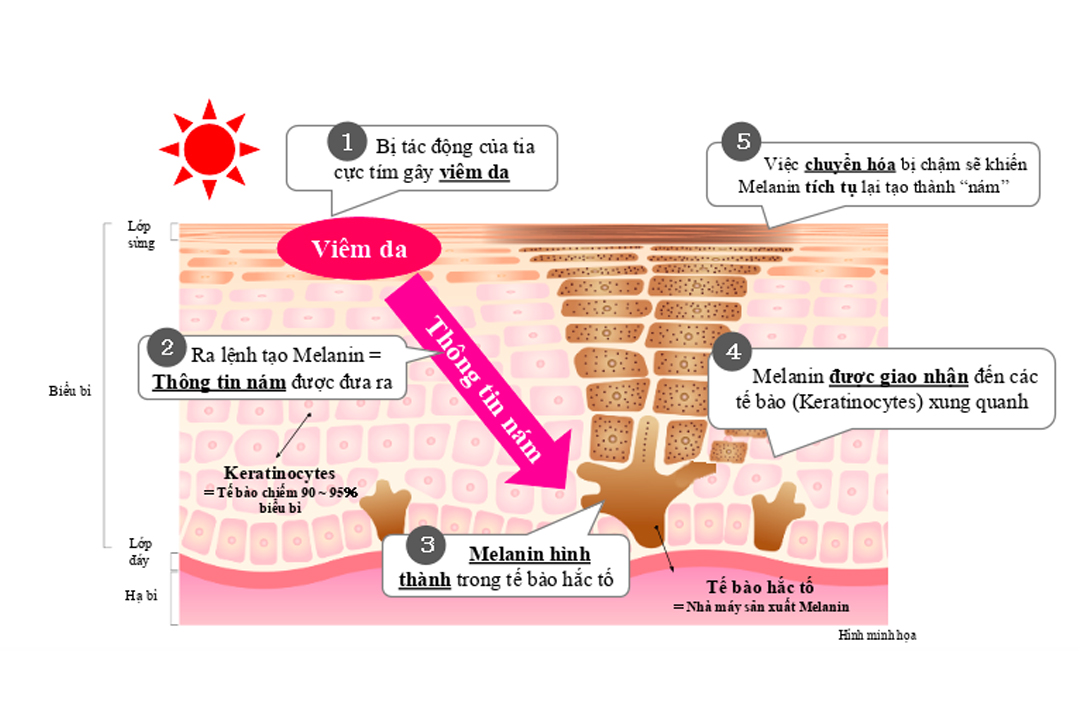 Cơ chế hình thành nám trên da và cách khắc phục
