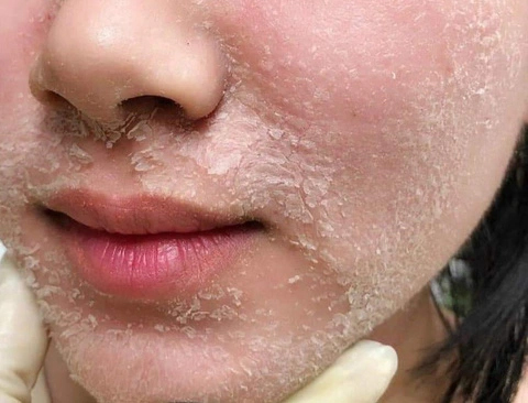Peel da mặt là gì? Ưu và nhược điểm cần biết